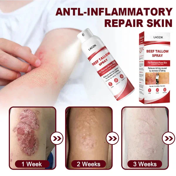 LAOZIK® Beef Tallow Spray for Itchy, Flaky Psoriasis Skin - Image 2