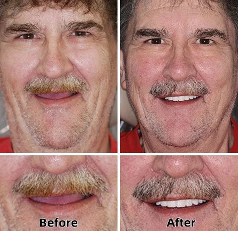 Laozik™-Advanced Custom-Fit Functional Dentures - Image 3